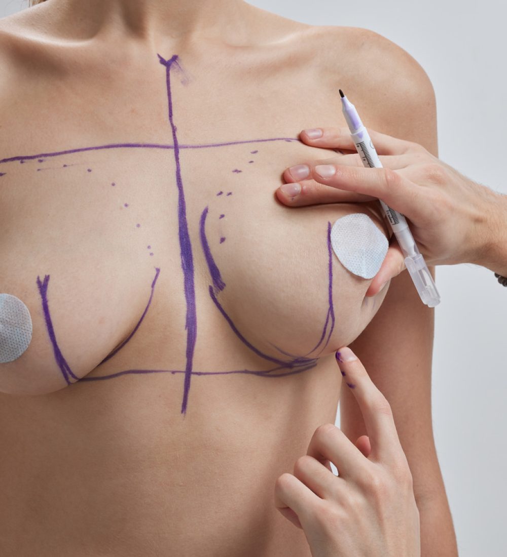 doctor-hand-drawing-lines-on-woman-breast-breast-2024-01-10-23-46-09-utc_Easy-Resize.com