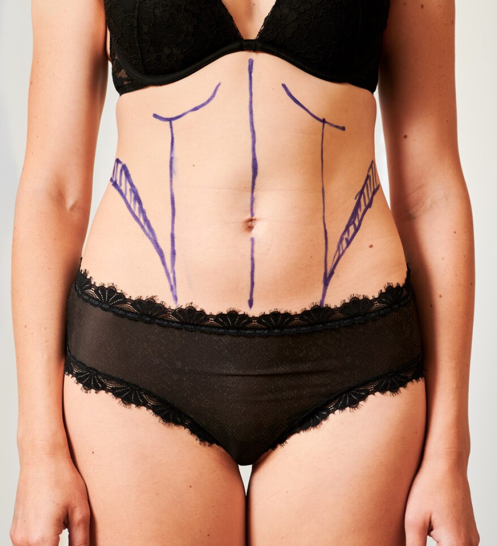 female-patient-body-with-marks-for-plastic-surgery-2023-11-27-05-35-37-utc_Easy-Resize.com